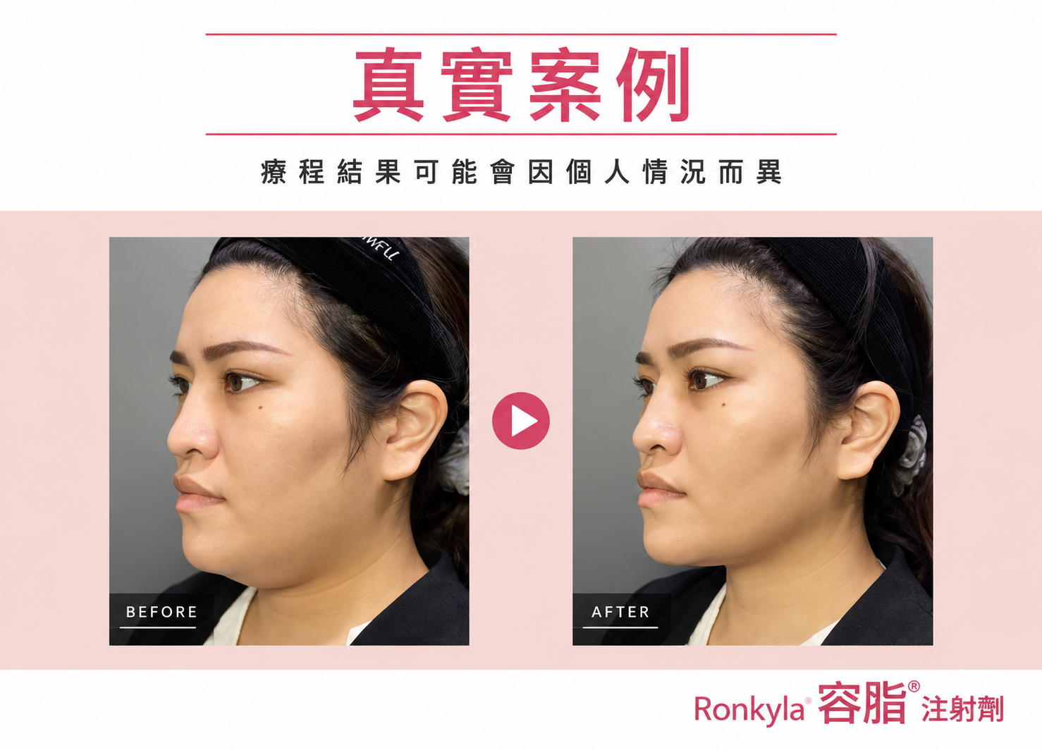 容脂針療程案例 1