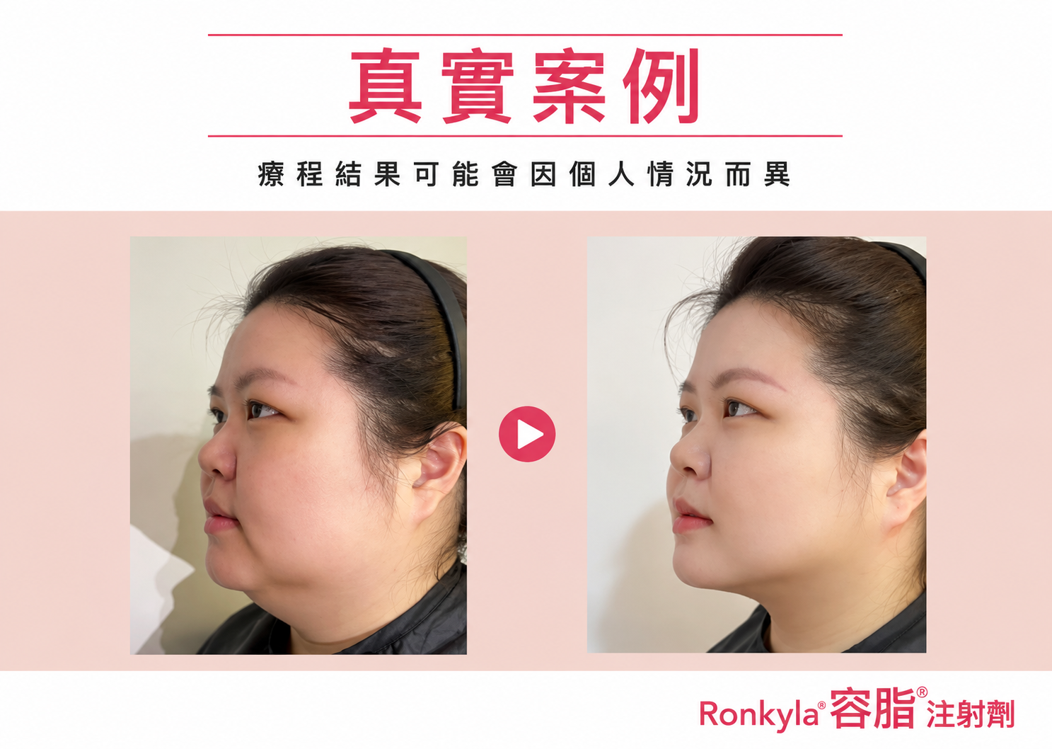容脂針療程案例 4