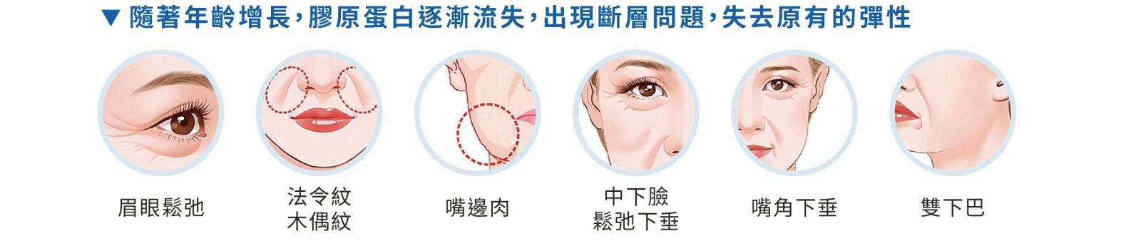 美特拉埋線拉提作用原理示意圖